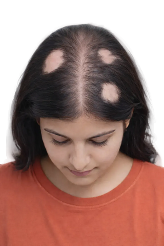 Visible coin-sized bald patches
